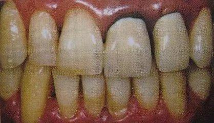 烤瓷牙和全瓷牙的优缺点是什么,钴铬合金烤瓷牙和全瓷牙优缺点