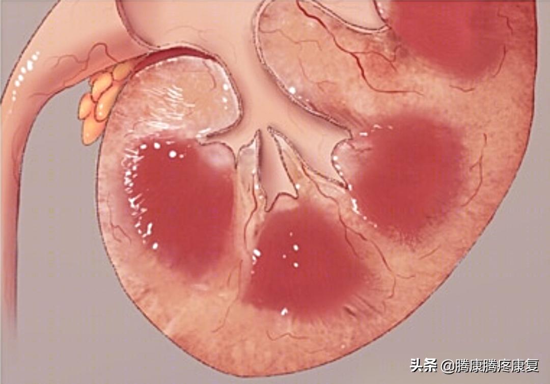 类风湿关节炎病因与发病机制,类风湿关节炎的病因与发病机制