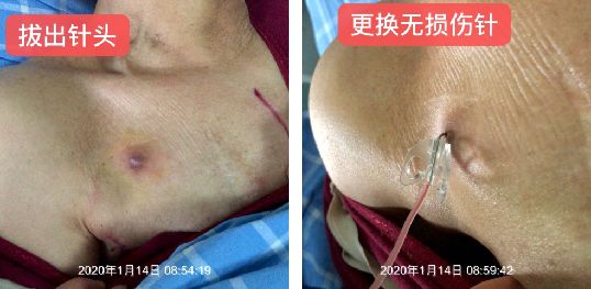 输液港不回血但输液通畅怎么办,输液港维护没有回血怎么回事