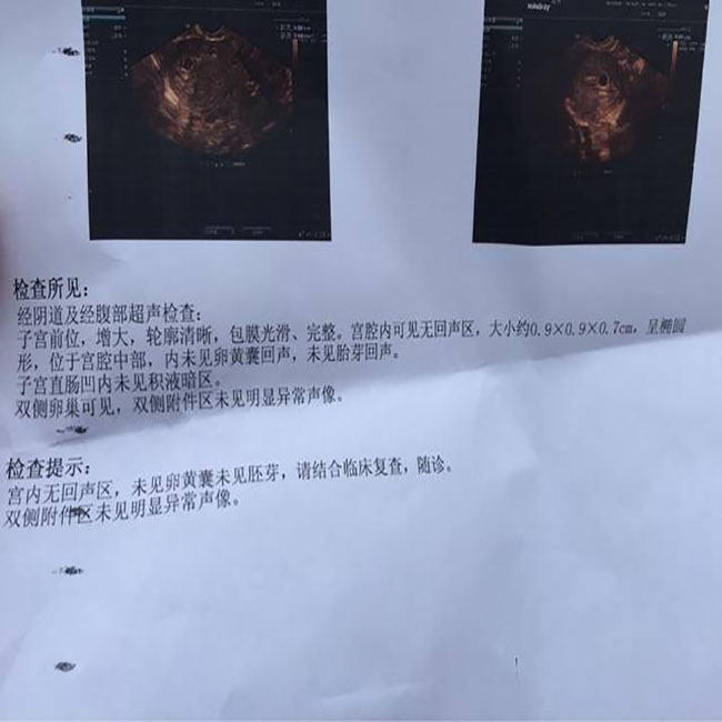 孕检未见卵黄囊什么意思,为什么孕检单子没有nt值