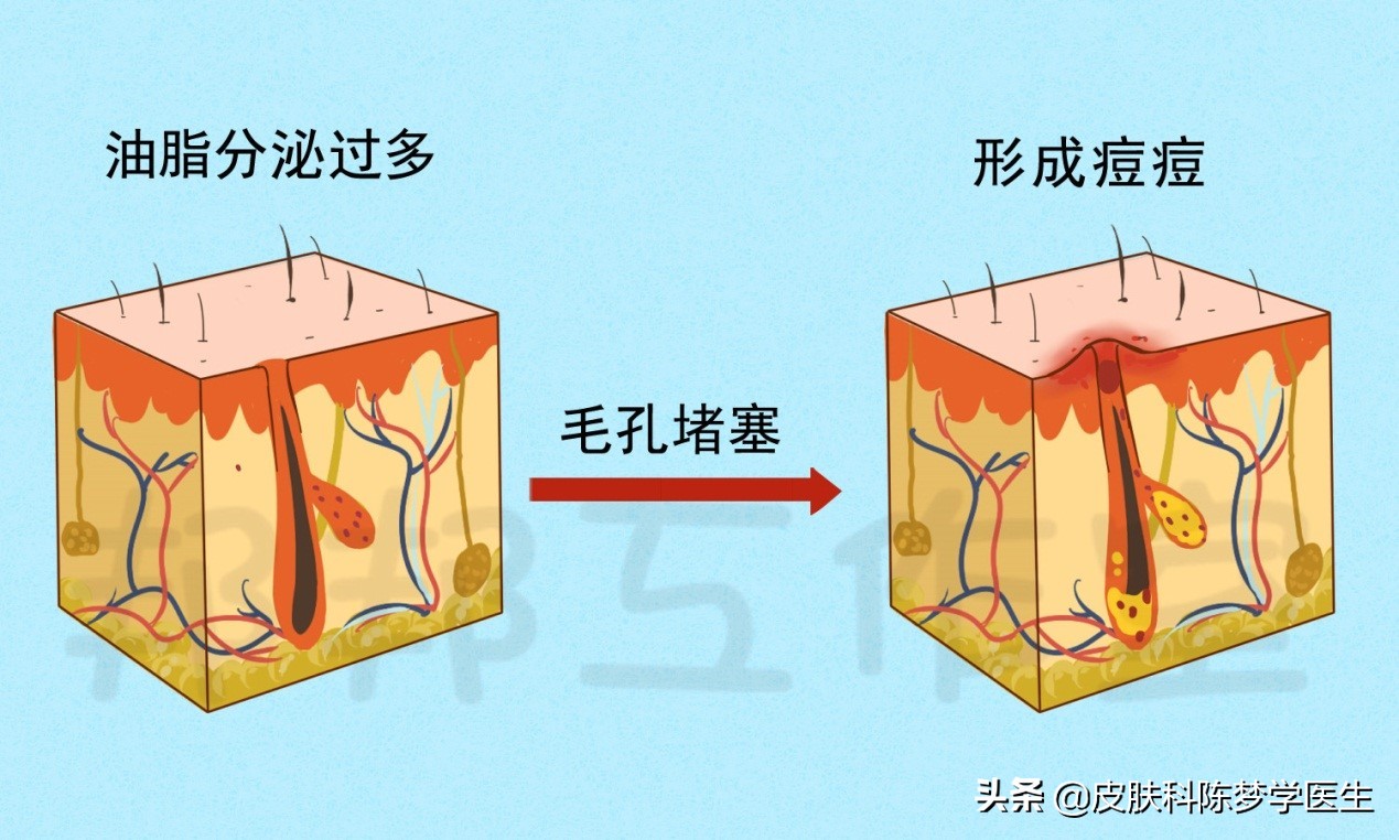 脸上青春痘用什么护肤品,青春痘抗组胺药物有哪些