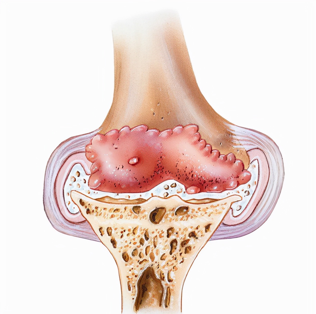 滑膜炎膝盖疼痛关节积水肿胀僵直,滑膜炎膝盖肿胀疼痛怎么样治疗