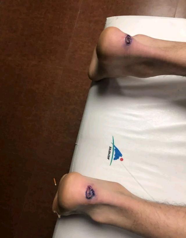 周琦伤情被曝,周琦伤情新消息