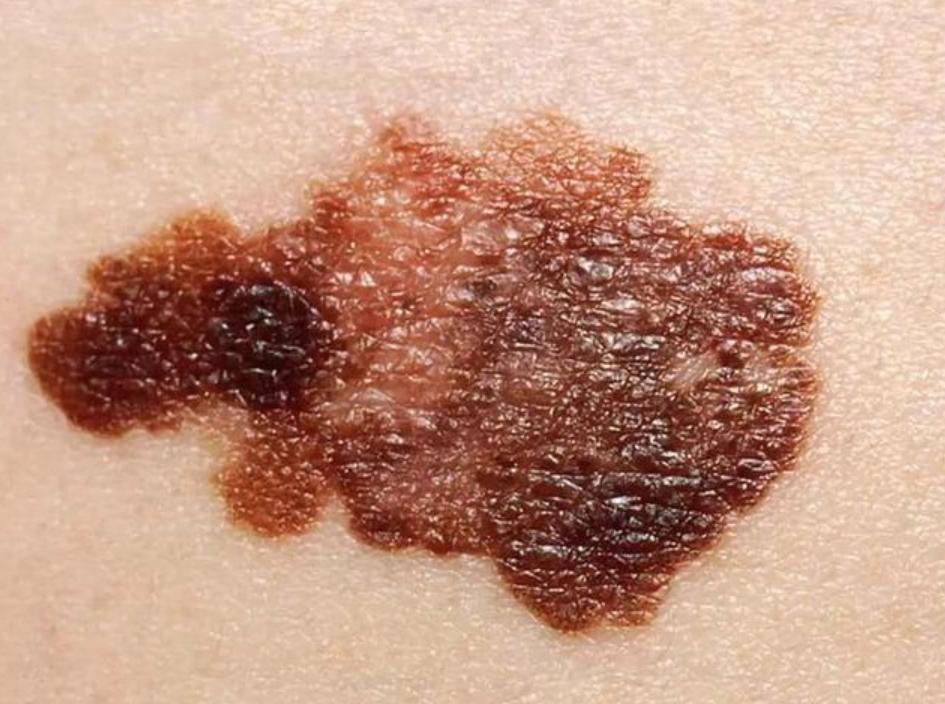 身上的痣自己会消除吗,身上的痣能随便去掉会死吗