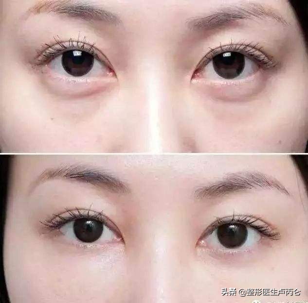 打肉毒素后多长时间可以做提眉,打完肉毒素眉毛下垂如何修复