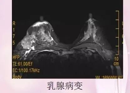 核磁共振能看出来哪些病症,核磁共振可以检查良恶性吗