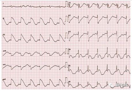 「彤心飞传」ST段广泛抬高伴QTc间期延长--临床诊断？