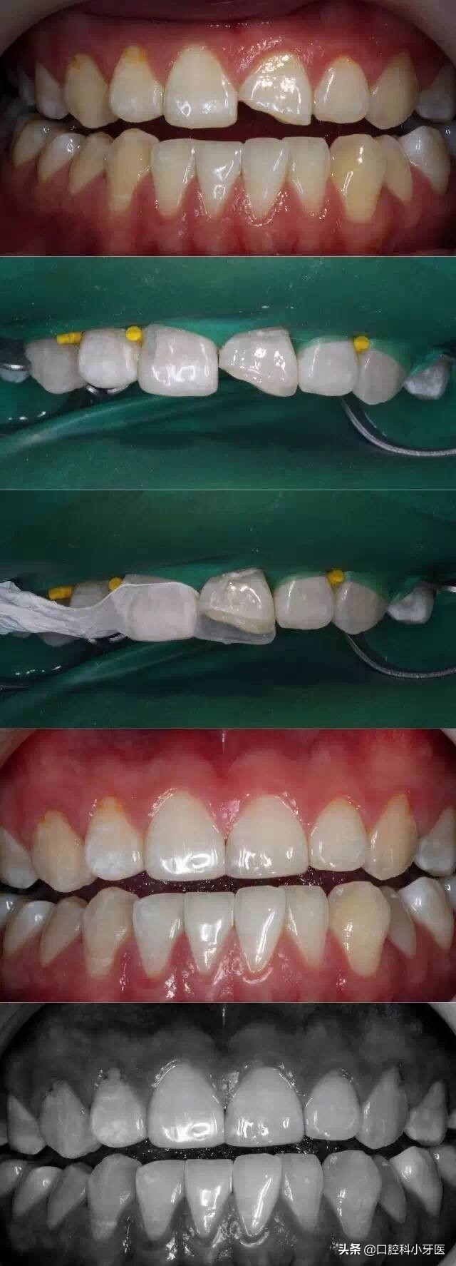 门牙马上要掉了怎么办,门牙连根掉了时间长还能安上吗