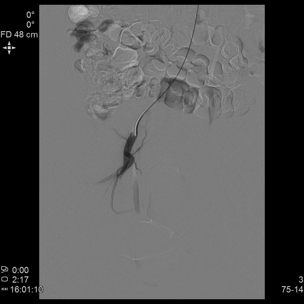 子宫肌瘤不能开刀只能化疗严重吗,子宫肌瘤介入栓塞治疗后注意事项