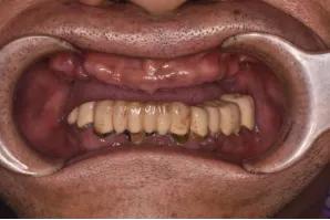 长沙牙齿种植的费用,长沙种植牙视频