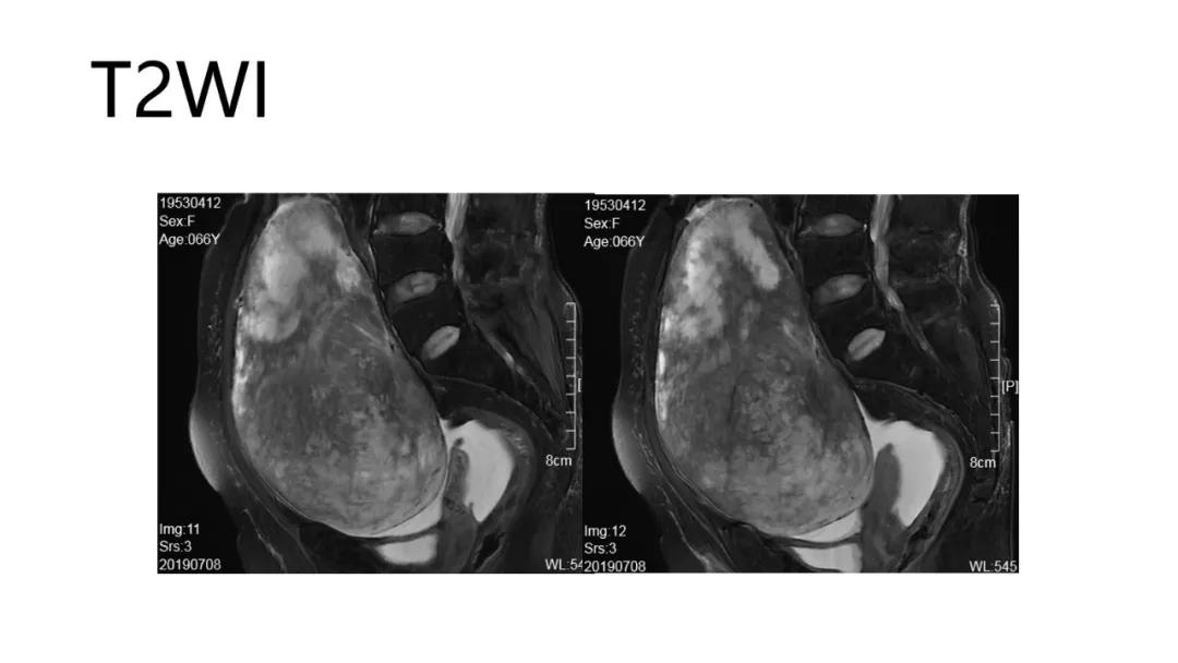 卵巢原发肿瘤的分析思路