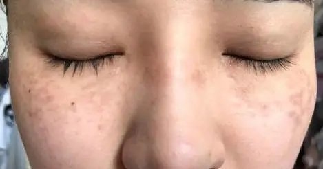 贝克氏母斑是皮秒好还是超皮秒好,皮秒跟超皮秒蜂巢皮秒有什么区别