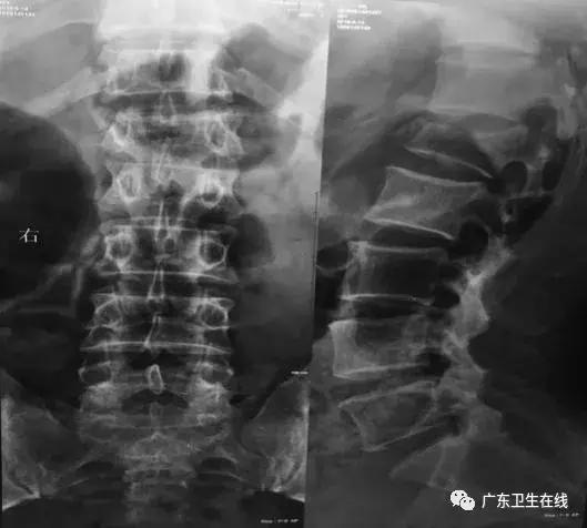 高处摔下腰椎压缩性骨折用药,高处跌落脊椎骨折需要手术吗