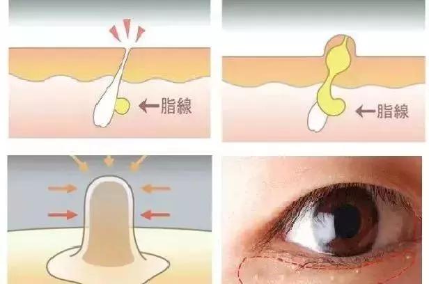 别再用针挑！用米澳拉，脂肪粒自己“掉”下来，效果胜过医美激光