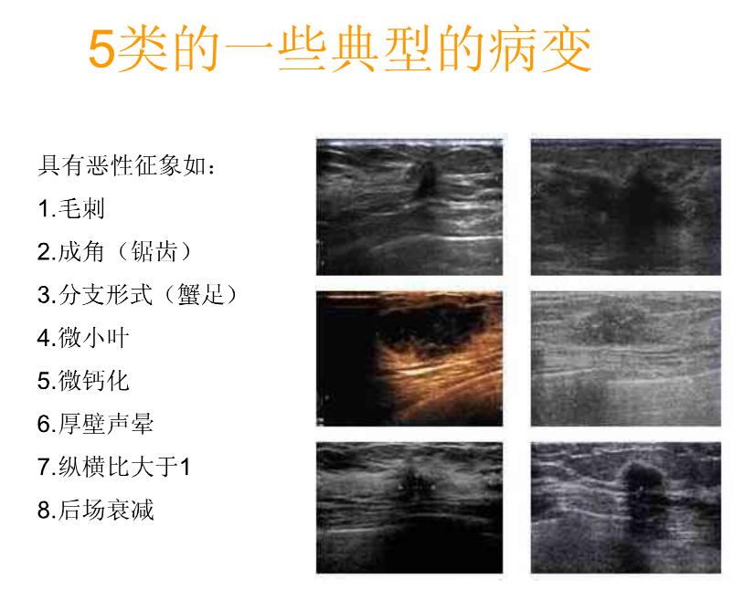 乳腺bi-rads分类有哪些,乳腺bi-rads的分类