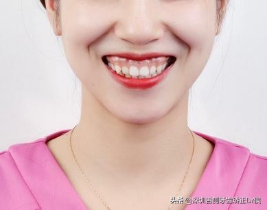 露龈笑怎么办,露龈笑矫正