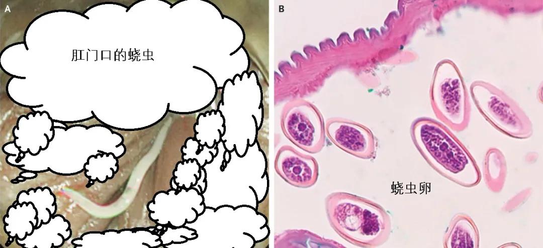 现在小学生要打虫吗,孩子打虫的季节