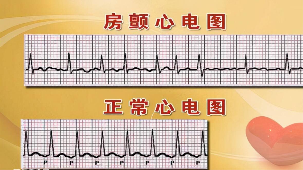 房颤的症状及治疗药物,什么是房颤房颤有哪些症状