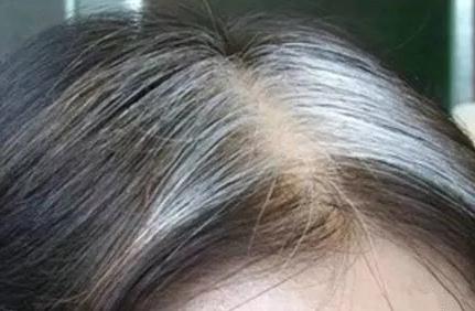 18岁高中生年纪轻轻长白发？医生：是身体出了问题