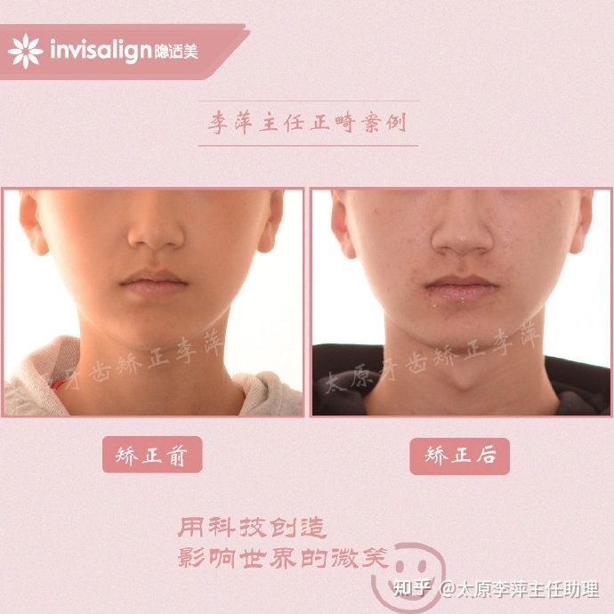 太原牙齿矫正靠谱吗,太原成人隐形牙套牙齿不齐