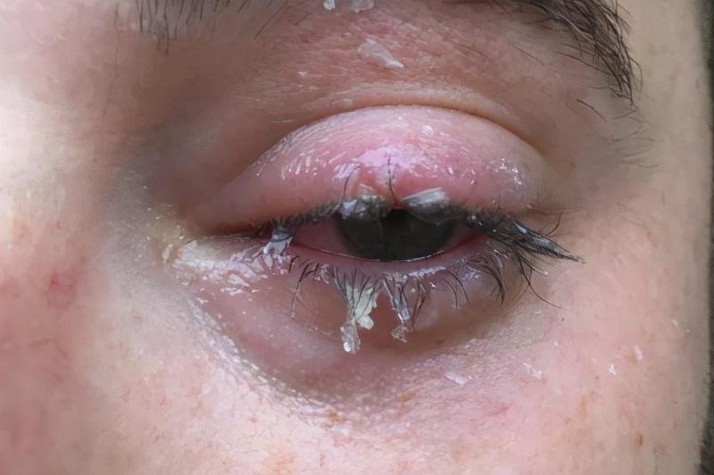 危险502误当眼药水福州6岁男孩,3岁儿童误将502滴入眼