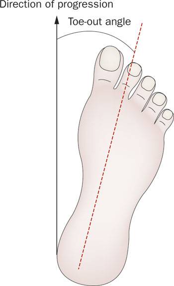 跑步时脚是外八字怎么纠正,膝盖内扣脚外八字跑步