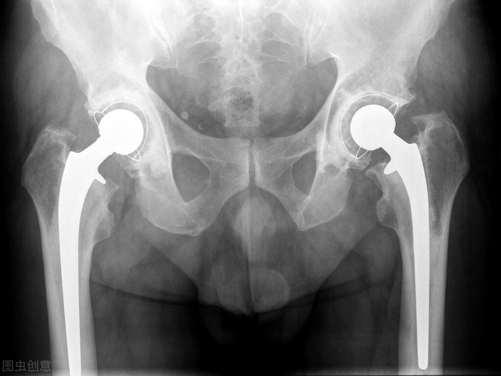 人工半髋关节置换术手术步骤,人工髋关节置换属于几级残疾