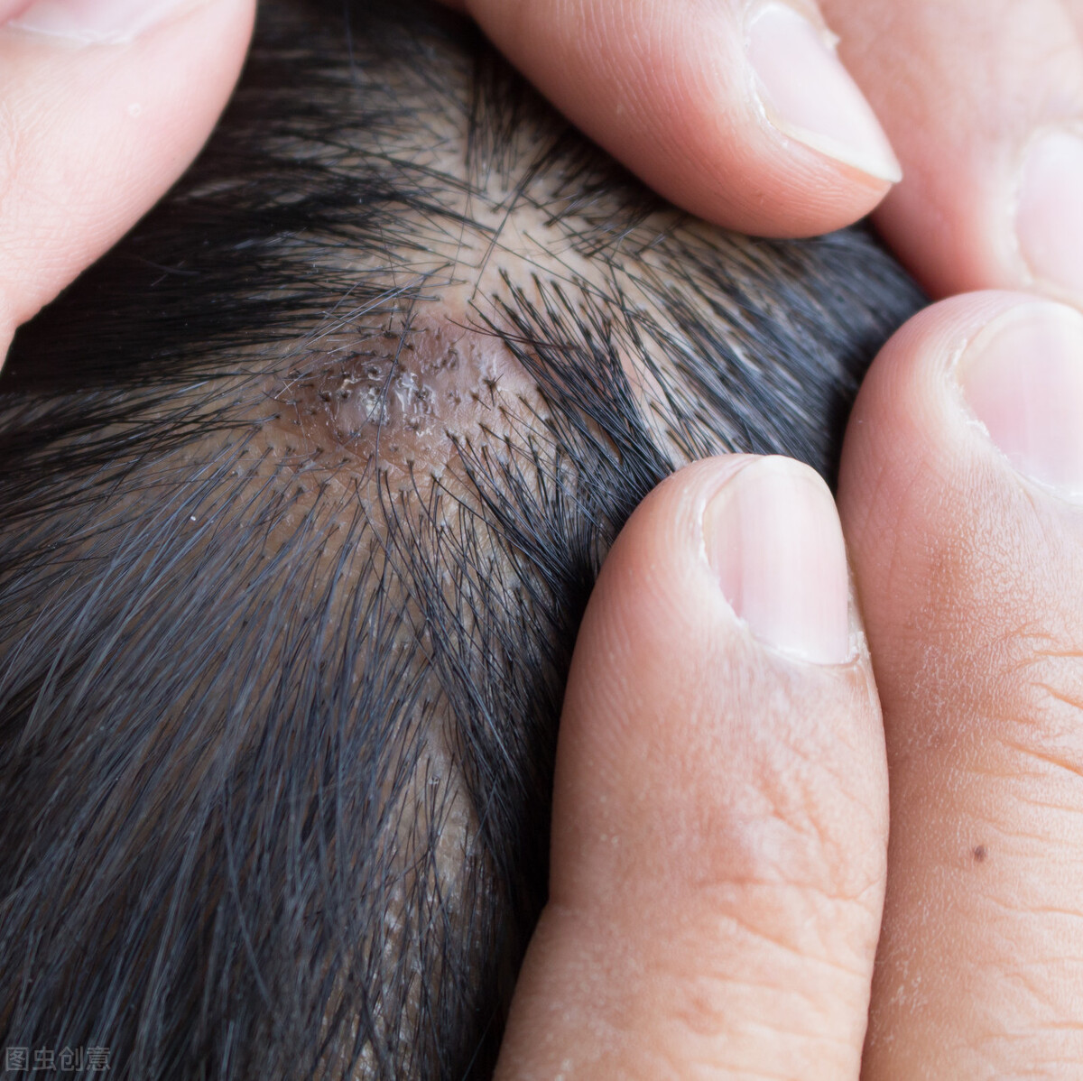头皮总能摸到小疙瘩很痒,头皮上摸着有结节