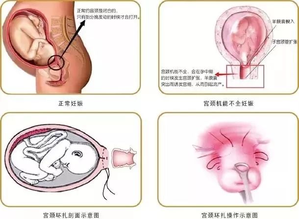 宫颈松能自行恢复么,医生说我宫颈小是好事儿吗