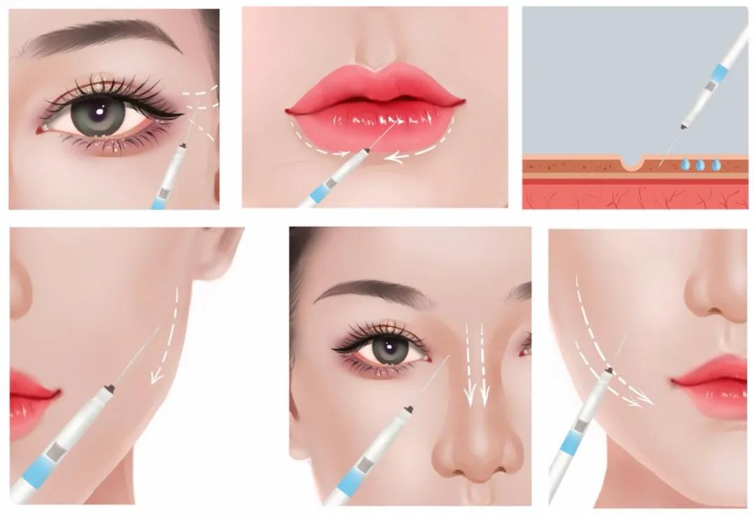 医生科普光子水光针,水光针专业知识分享