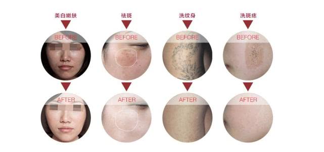 激光美容注意事项和禁忌症,激光美容靠谱吗一个小实验告诉你