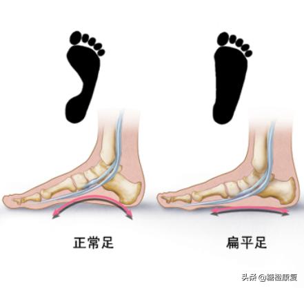 扁平足的锻炼矫正方法,10岁小孩扁平足的矫正方法