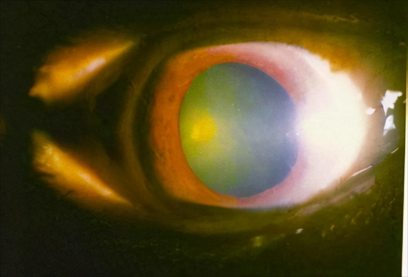 眼突眼胀耳鸣腰痛,眼胀畏光头痛怎么回事