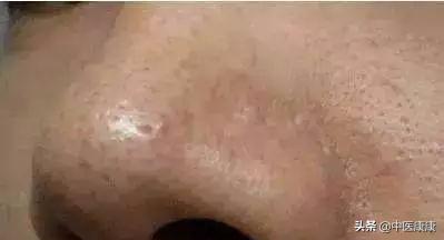 小米粒痘痘怎么快速消除,小米粒痘痘怎么去掉