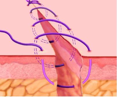 面部缝针后怎么才能不留疤,孩子脸上缝针留疤怎么祛除