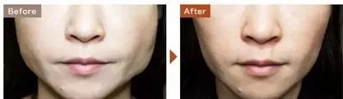 瘦脸针科普,科普打瘦脸针脸会凹陷变松吗