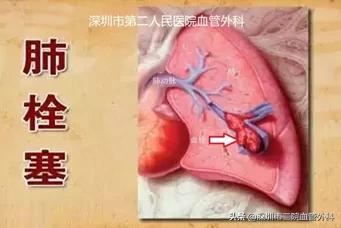 新冠引起静脉血栓怎么治疗,静脉血栓是新冠高危人群吗