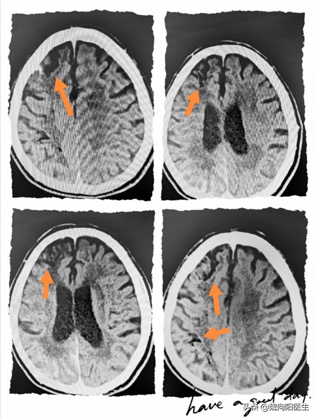 脑血管畸形介入栓塞后并发症,脑血管造影并发症