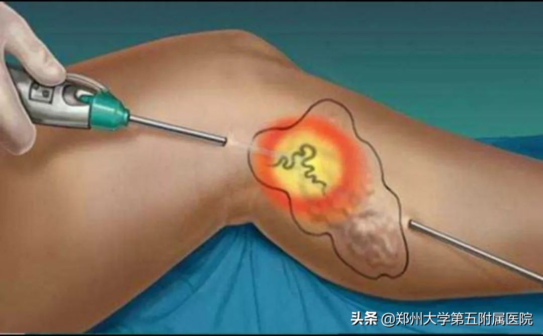 静脉曲张远离老烂腿,下肢静脉血管曲张怎么办