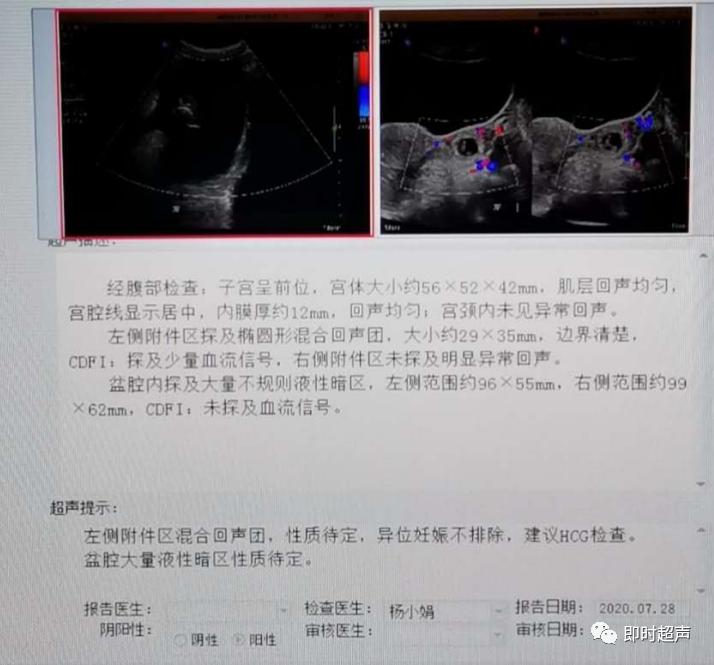 你想不到的一种病,宫外孕的遗憾