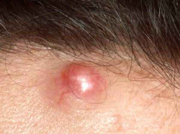 囊肿长哪地方,囊肿一般长在什么地方