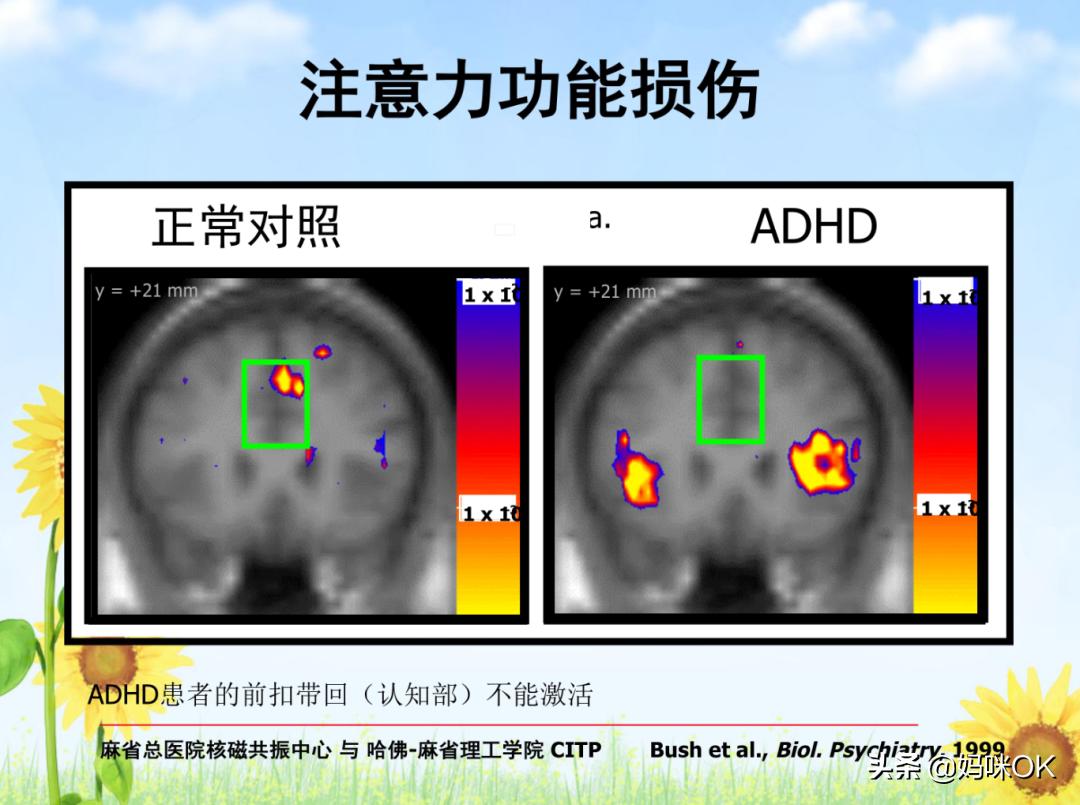 医院检查孩子注意力缺陷怎么办,重度注意力缺陷孩子怎么办