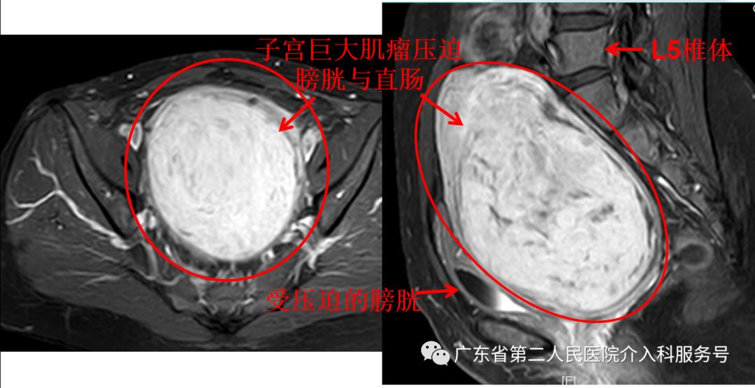 子宫肌瘤引起大姨妈一直来怎么办,子宫肌瘤大姨妈多怎么办