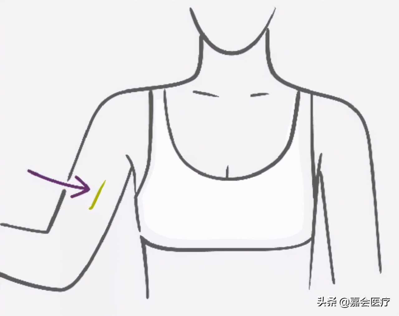 不吃药不上环怎么避孕,皮埋避孕副作用可吃药缓解吗