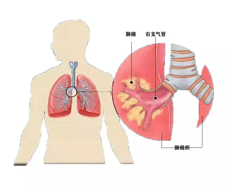 中央型肺癌和周围型肺癌的ct区别,中央型肺癌CT和支气管镜能看出吗