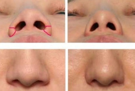30岁怎么解决鼻翼两边下垂,鼻翼下垂但是中庭长怎么整容