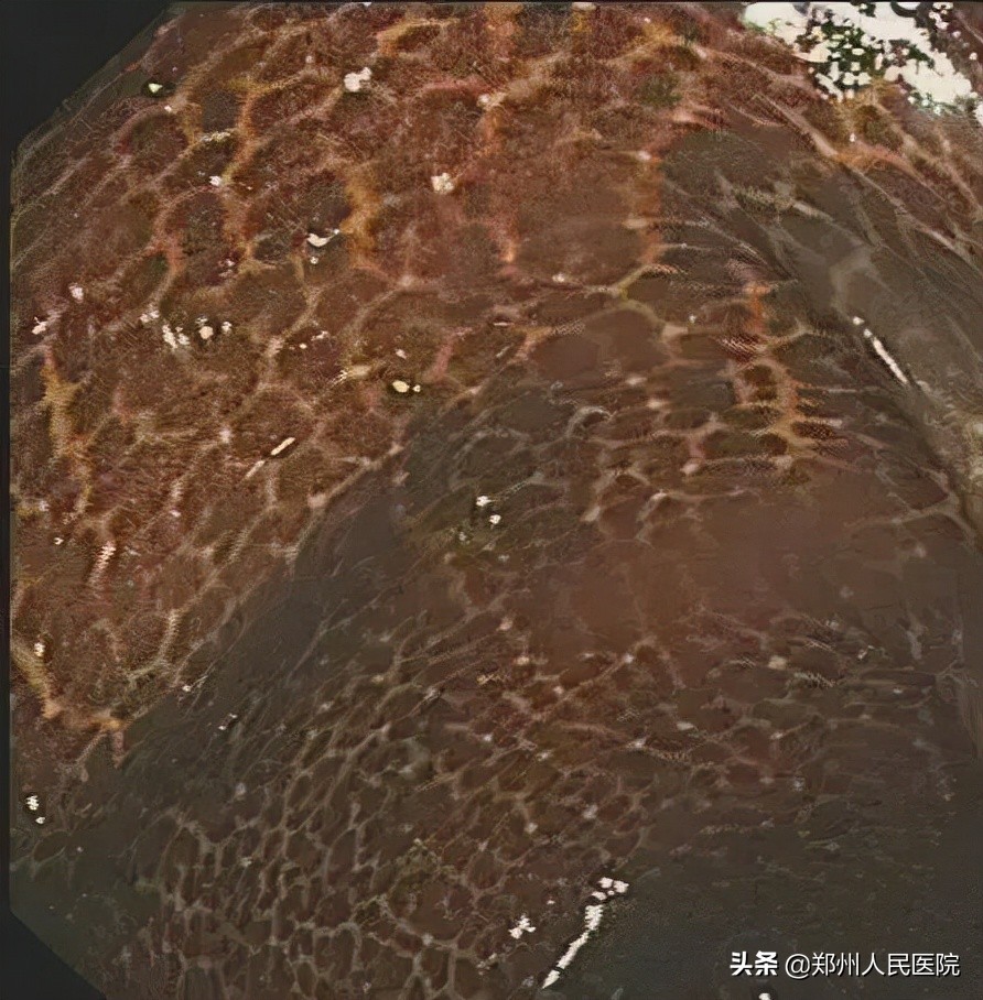 吃酵素体内肠子吃成了蛇皮状,吃了酵素便秘怎么调理