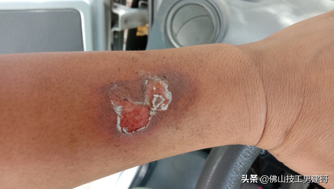 手部烫伤后的康复视频,手烫伤处理视频