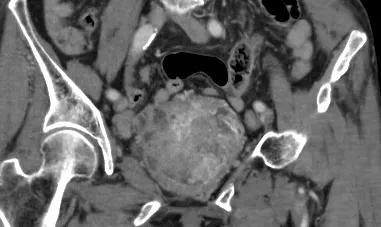 膀胱肿瘤患者吃什么保健品,膀胱肿瘤特效药