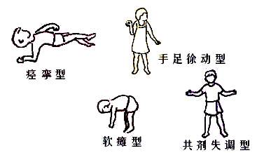 小儿脑瘫高危儿早期干预视频,对脑瘫患儿的心理和行为干预